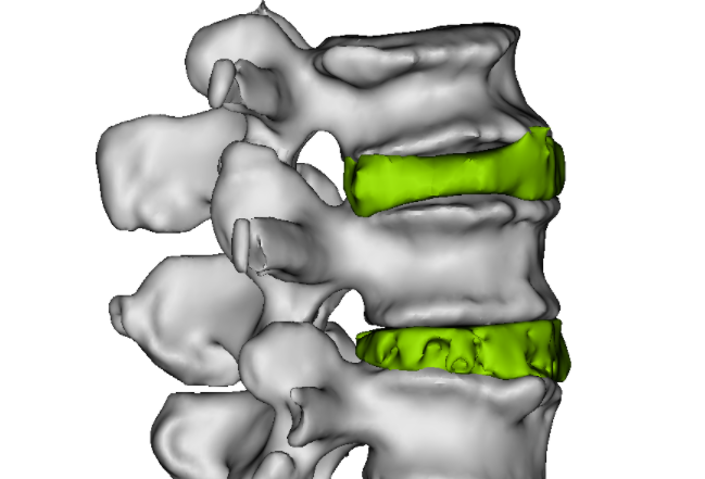 脊柱6级截骨三维图谱（Mimics 21.0制作）