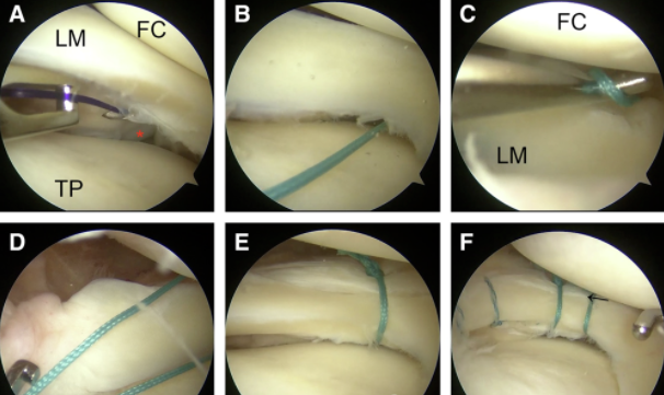 【手术技术】外侧半月板腘肌裂孔腱区损伤全内缝合技巧