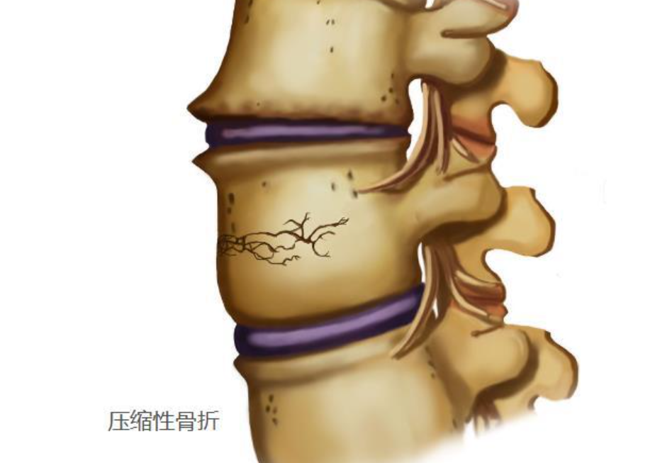 骨质疏松性椎体压缩骨折诊治专家共识（2021版）