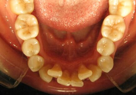 牙列拥挤减少牙量的几种常见操作，值得收藏！