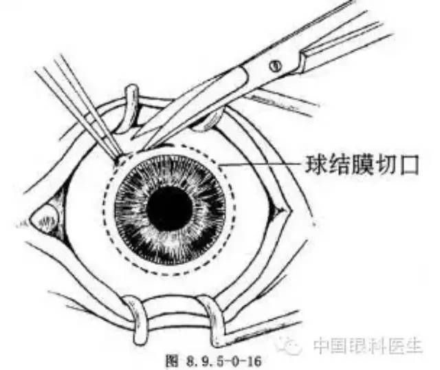 玻璃体手术步骤及基本操作