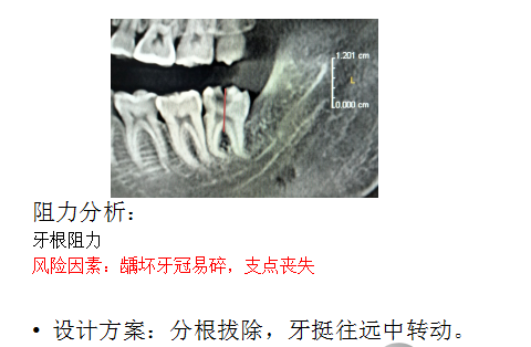 被低估的下颌正位智齿拔除，给年轻牙医提个醒