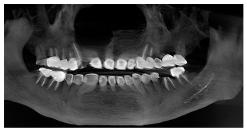 大量根充糊剂进入下牙槽神经管10年 观察1例报告