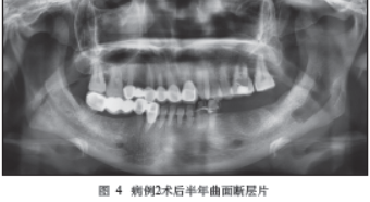 如何规避根管超填可能导致的下牙槽神经损伤