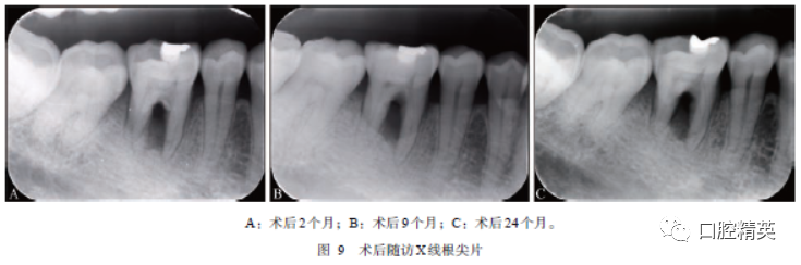 下颌第一磨牙根分叉病变治疗随访27年1例