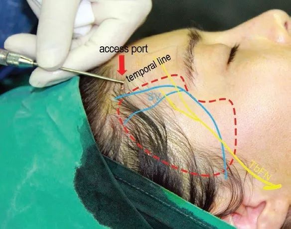 【自体脂肪】颞区脂肪室的应用解剖