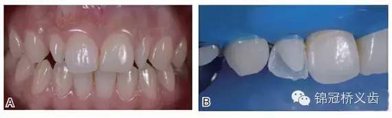 关于口腔美学修复适应症选择的思考