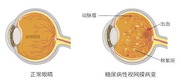 一文了解糖尿病视网膜病变的治疗药物大全