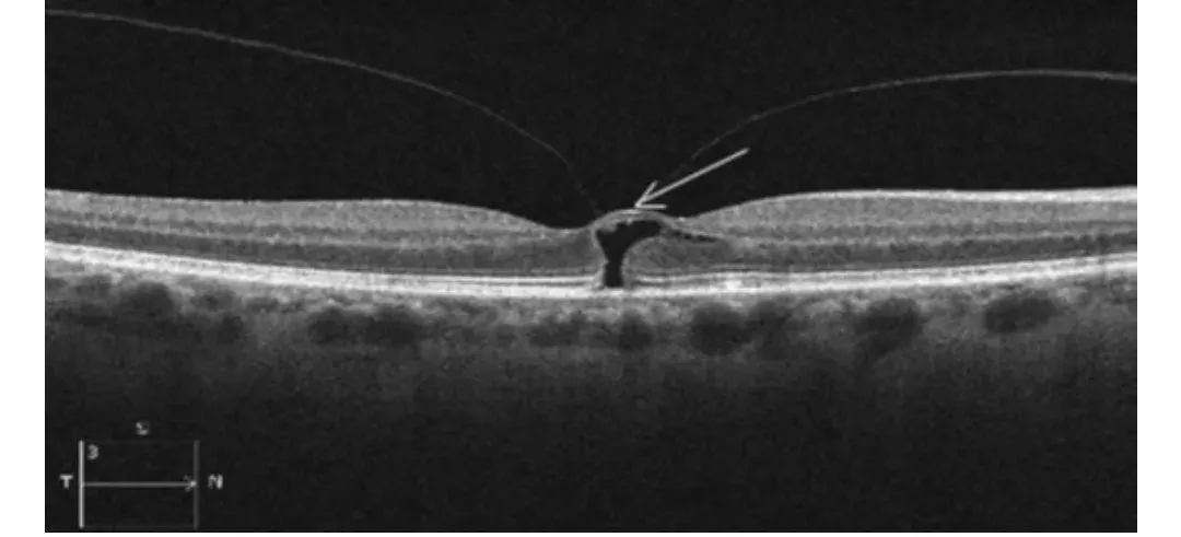如何辨别OCT检查中的黄斑水肿？详细图解来了！