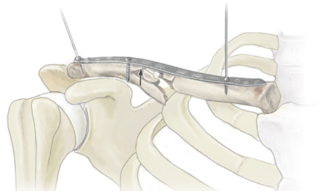 MIPPO技术治疗锁骨骨折的手术步骤及其相关问题