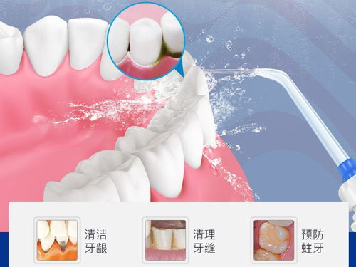 牙结石：我是如何成为口腔头号杀手的！