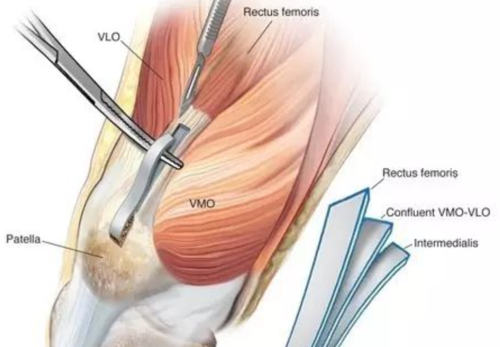 【手术技术】自体股四头肌重建前交叉韧带