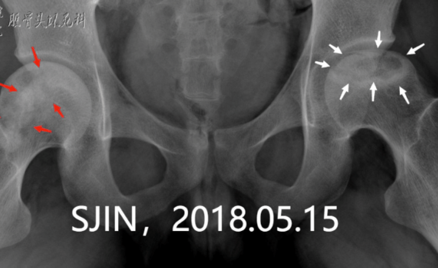 2~3期股骨头坏死，冲击波和植骨手术哪个好？