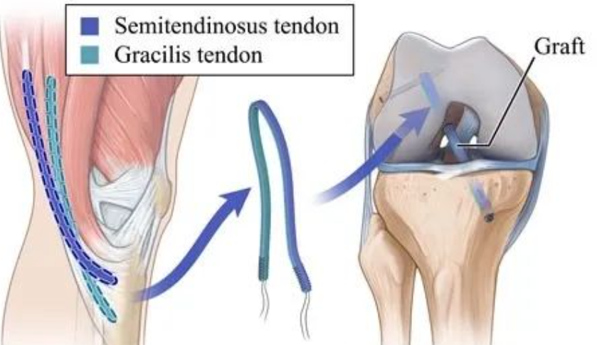 【手术理念】自体肌腱重建前交叉韧带太细该怎么办？