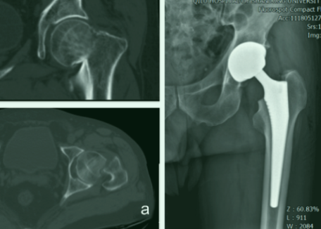 全髋关节置换术中髋臼假体周围隐匿性骨折