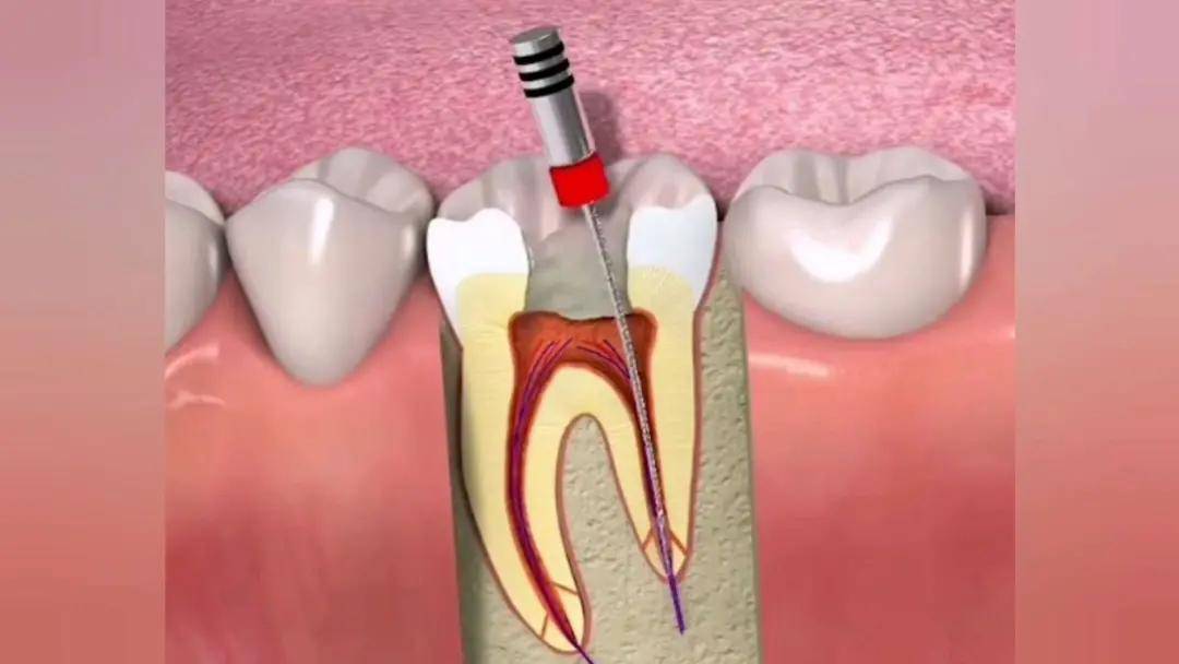 根管治疗容易出现的11个问题