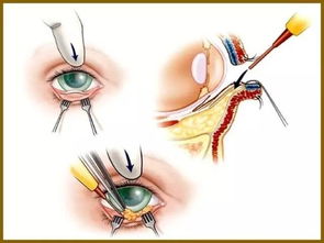 眶缘多点骨钻孔固定中面部提升在辅助矫正下睑成形术后重度下睑异位中的应用