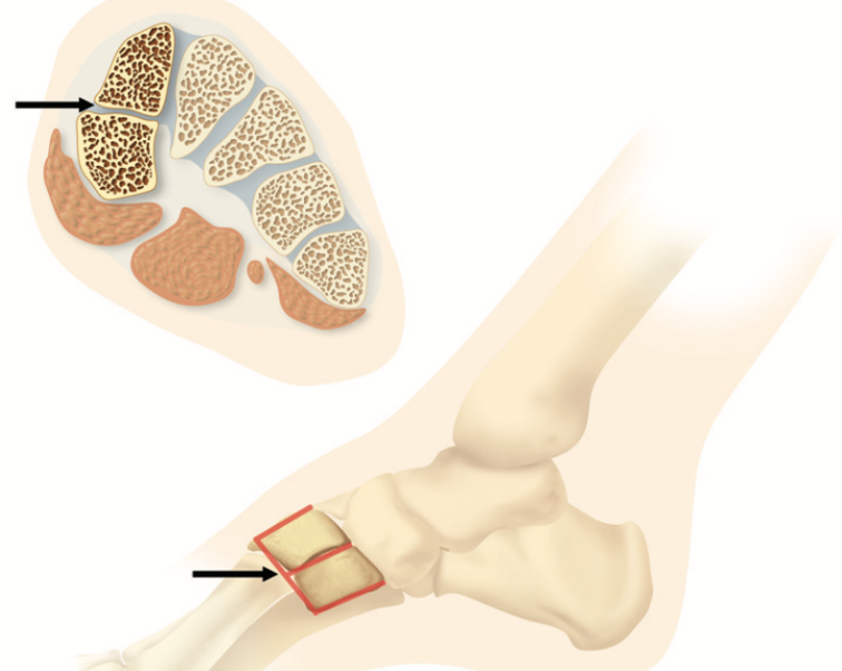 【足踝病例】二分内侧楔状骨（Bipartite Medial Cuneiform,BMC）