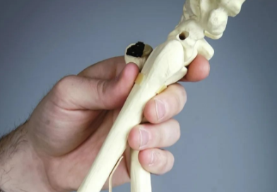骨折手法复位的几项基本原则