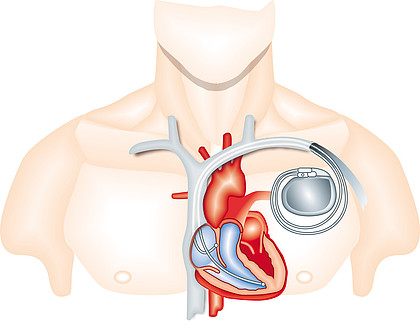 关于心脏起搏器，你了解多少？