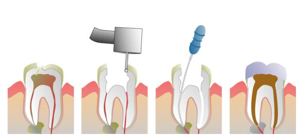  一组动图让你看懂根管治疗！