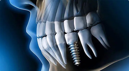 史上最详细的种植牙流程