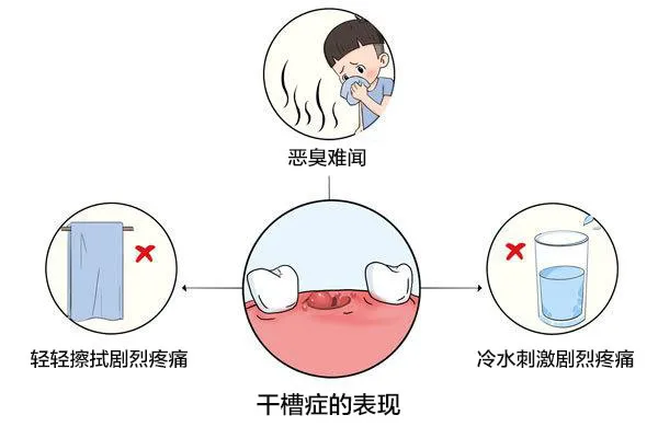 干槽症的治疗方法