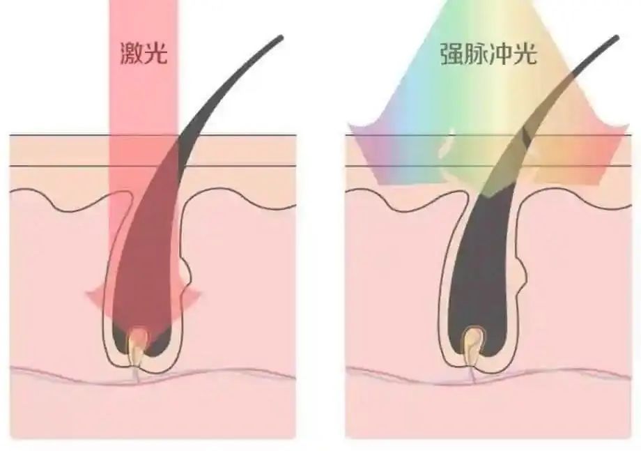 激光 VS 强脉冲光，不同肤质怎么选择？