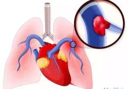急性肺栓塞的诊断利剑——心电图
