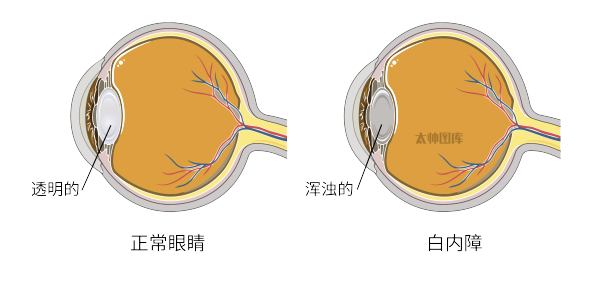 白内障超声乳化手术的术中并发症及处理