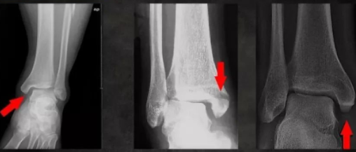 特殊踝骨折——腓骨高位骨折真的不需要固定吗？