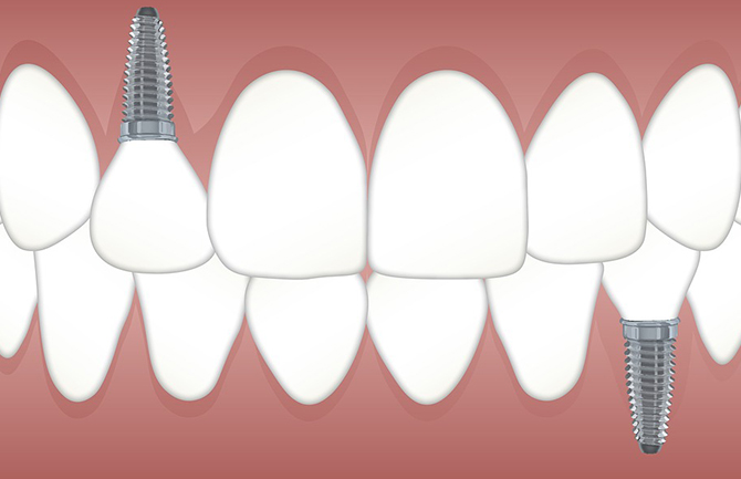  史上最全的种植牙全过程介绍！ 更加全面！更加详细！