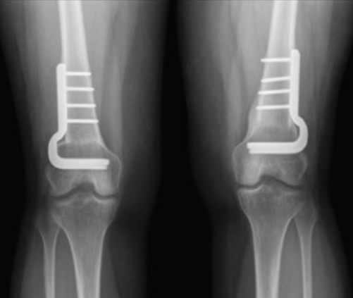 股骨远端短缩截骨术治疗全髋关节置换术后坐骨神经麻痹