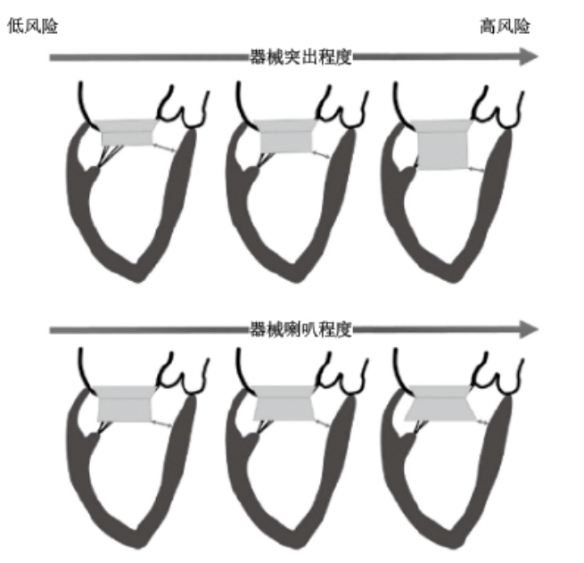 【综述】经导管二尖瓣置换技术难点概述