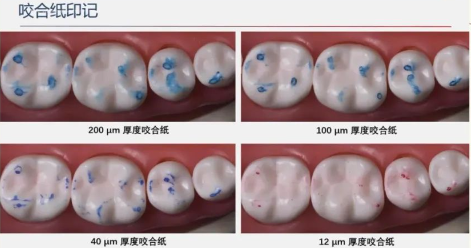 咬合纸的临床应用