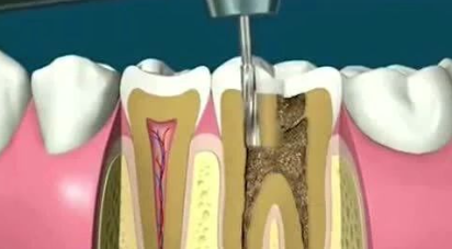 根管消毒及疼痛控制