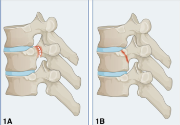 胸椎骨折的四柱理论，根据分类情况提出治疗建议