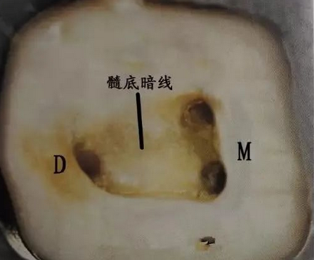 寻找根管口的一些方法总结