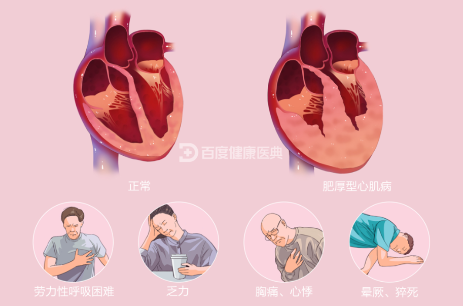 肥厚型心肌病简介及临床试验