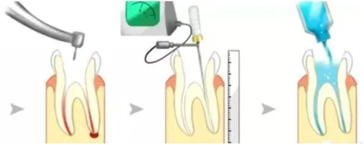 想要乳牙根管治疗做的优秀，这10个细节一定要把握！