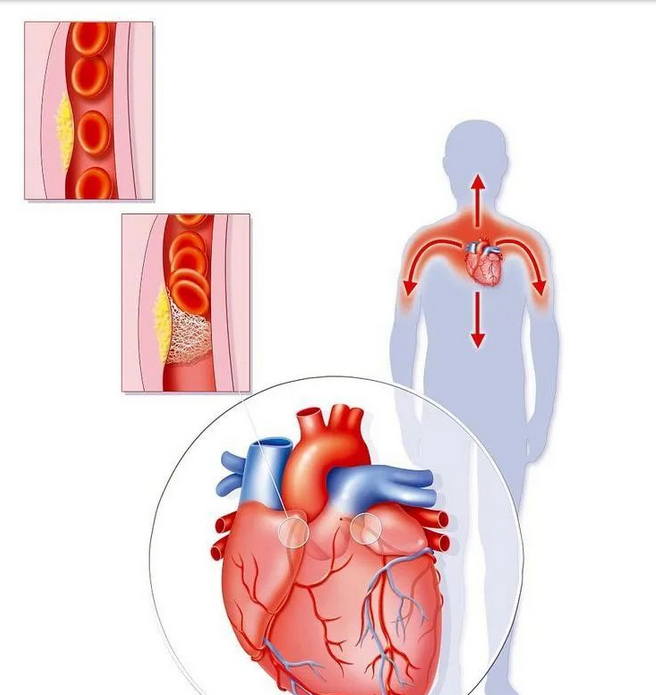 冠状动脉造影明确冠状动脉起源异常的发生率及分类