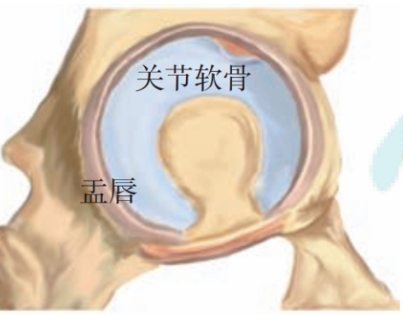 【骨科前沿】髋臼股骨撞击症髋臼软骨损伤的发生机制及诊疗进展