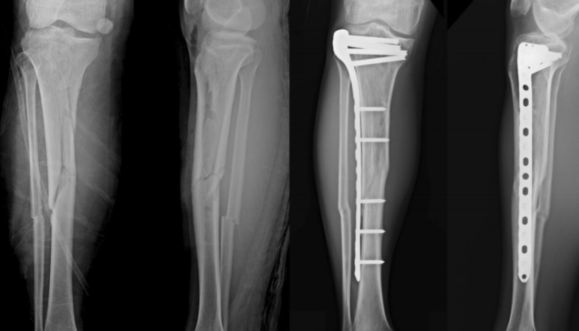 胫骨平台骨折合并同侧胫骨干骨折的两种内固定方式
