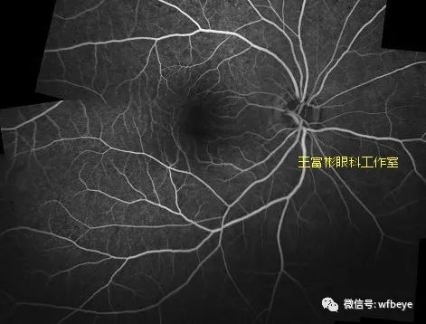 OCTA：视网膜动脉“黑鞘”，与“白鞘”大相径庭