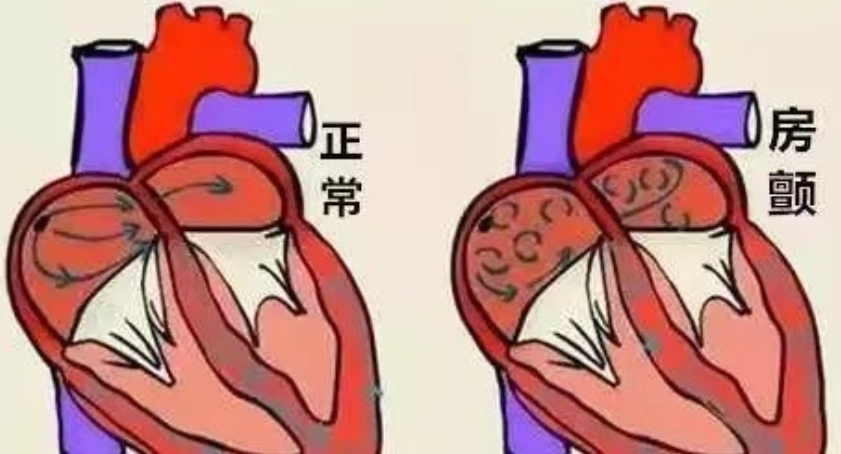 射频消融 VS 冷冻消融，关于房颤消融，您了解多少？