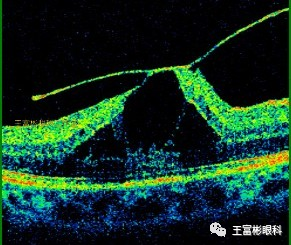 玻璃体黄斑牵拉综合征一定要手术吗？病例解析