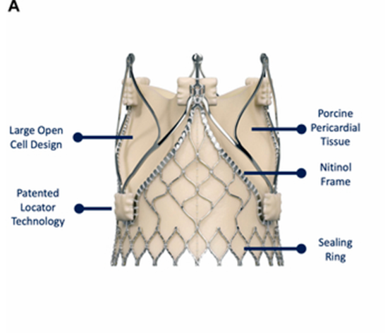 全球首例经腔静脉 TAVR 治疗单纯主动脉瓣反流成功实施