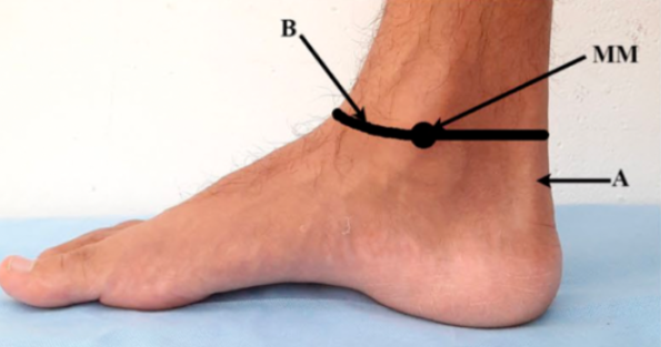 Ankle Block——基于解剖标志的踝部神经阻滞技术