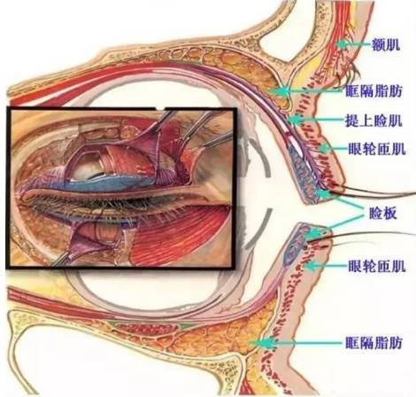 上睑下垂矫正术的操作步骤