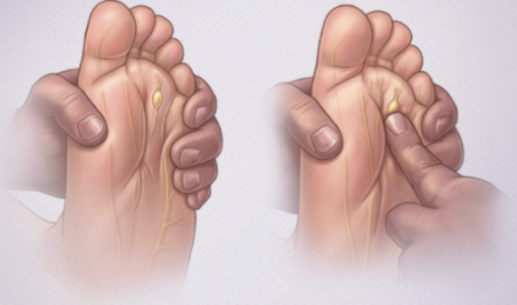 【JAMA​综述】三大常见的疼痛相关足踝疾病